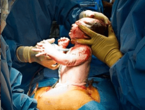 Do we really need so many C-section baby deliveries?
