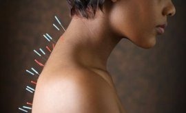 Introduction to Acupuncture – Part 2